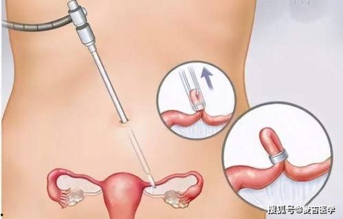 做结扎手术视频真实,真实手术视频深度解析